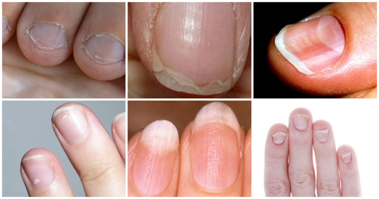 hur får man vitare naglar